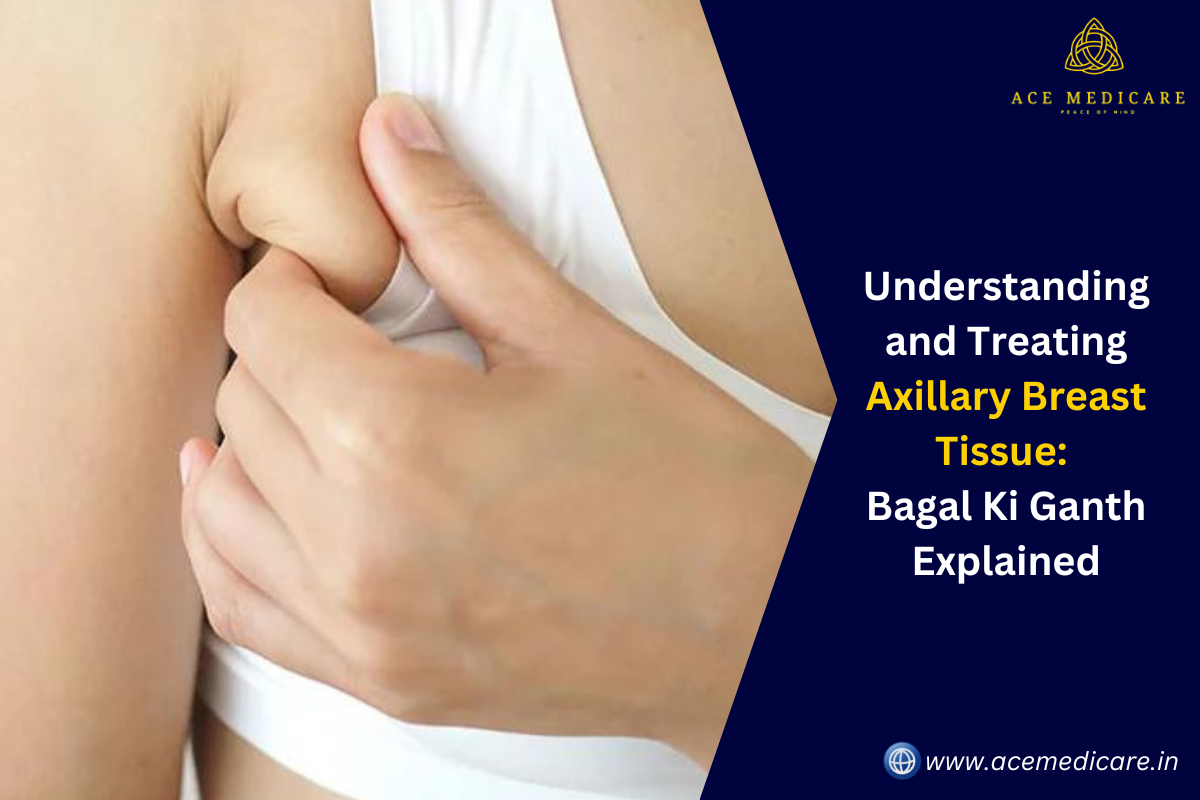 Understanding and Treating Axillary Breast Tissue: Bagal Ki Ganth Explained